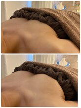 スマイルクルー(SmileClue)/初回ビフォーアフター症例