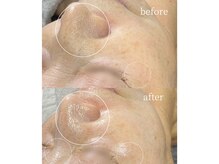 サロンナナジュウニ(Salon72)/たるみ/シワ