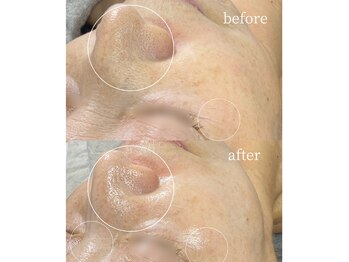 サロンナナジュウニ(Salon72)/たるみ/シワ