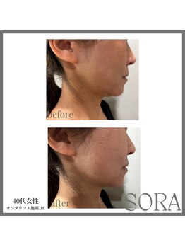 青空 天神大名店(SORA)/オンダリフト1回60kj