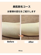 ミレア(Mirea)/20年の実績☆この時期人気の脱毛