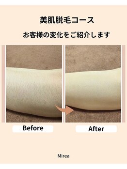 ミレア(Mirea)/20年の実績☆この時期人気の脱毛