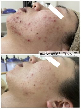 ルルボーテ(Loulou Beaute)/waxxxx+VOSサロンケア