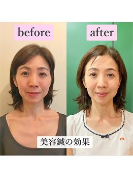 ゲンキ鍼灸整骨院 かどの(Genki鍼灸整骨院)/美容鍼