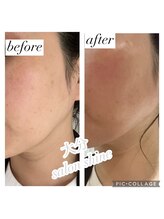 サロンシャイン(Salon Shine)/REVIハード１回ハーブ