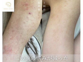 サロンエヌ 久留米店(Salon N)/二度腕のざらつき、毛孔〇苔癬