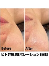 Sスタイルスタジオ 福岡天神/エレクトロポレーション1回目