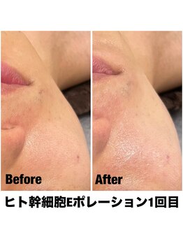 Sスタイルスタジオ 福岡天神/エレクトロポレーション1回目