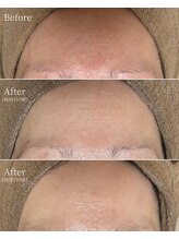 エース(ACE.)/おでこのシワ改善！ハリ＆弾力