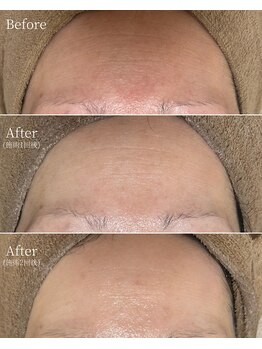 エース(ACE.)/おでこのシワ改善!ハリ&弾力