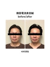 ビハダ(BIHADA)/微弱電流美容鍼Before/After