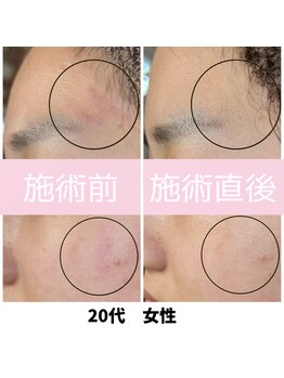 ローマサロン/効果即実感!