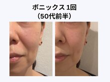アユアラングレース/50歳前半・1回/頬の毛穴・法令線