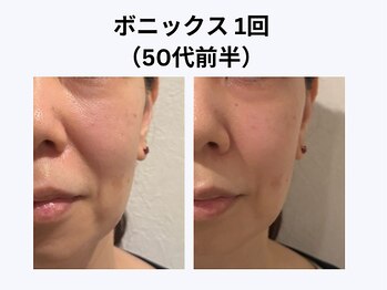 アユアラングレース/50歳前半・1回/頬の毛穴・法令線