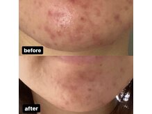 ディライト 名古屋駅店(Delight)/ハーブピーリング　ニキビケア