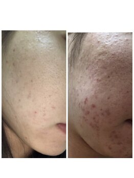 ザ シー タイムレスビューティ(THE SHE)/20代お客様症例写真