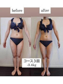 レナトゥス 銀座(Renatus)/3回Before&After【美脚/銀座】