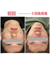 ライフ美容整体院 恵比寿(Life美容整体院)/MEN'S ニキビケア