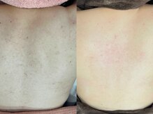 ハーブピーリング肌質改善専門店CHARIRE　松江店