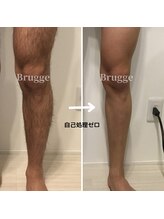 ブルージュ(Brugge)/脱毛効果が抜群です！