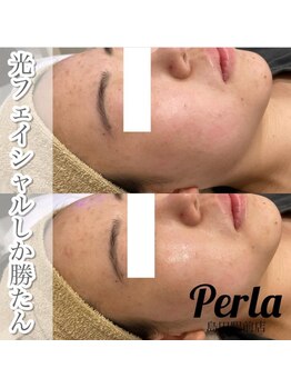 ぺルラ 島田駅前店(Perla)/光フェイシャル