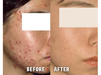 アクネ菌ケア専門サロン ベネーブ 武蔵小杉店