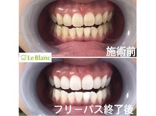 ルブラン 奈良店(Le Blanc)/魅力的すぎな歯！！