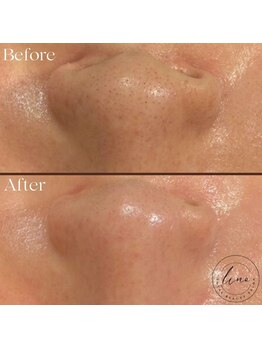 リノ(Lino)/BeforeAfter