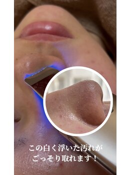 エース(ACE.)/毛穴の脂汚れ、角栓ごっそり!