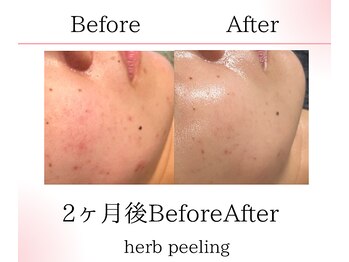 サロンツキ(salon tuki)/ハーブピーリング症例
