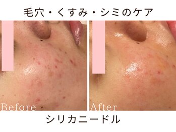 リリアン(lirien)/毛穴/毛穴ケア/毛穴洗浄/駒込