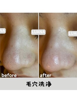 ルアナ 北谷店/毛穴洗浄毛穴ケア 《沖縄/北谷》