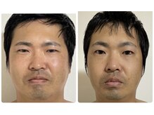 カナエルサロン 旭川(KANAERU SALON)/【小顔ケア】症例☆
