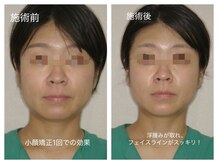 プラスホワイト 久我山/小顔矯正　1回でこの効果！！