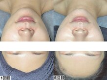 アンドミー 名駅(&me)/敏感肌にも優しいピーリング＊