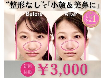 ラプリシュシュ 岡山店(Raplit)/隆鼻+輪郭矯正40分10回