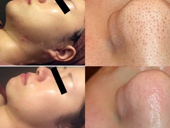 クー 池袋(KOO)の写真/【韓国最新美容】お肌を傷めず育てる事に特化した当店人気のララピール♪美と癒しの空間をご提供◎
