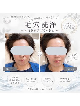 セルパンブラン 東区(Serpent Blanc)の写真/【熊本東区/毛穴洗浄】詰まり・黒ずみを徹底ケア!熊本初のよもぎ蒸し×毛穴洗浄で透明感溢れるつるん肌へ♪