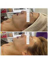 サロンドリシェス(Salon de RICHESSE)/陶肌ハーブピーリング！（左） 1