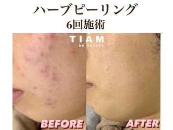 ル ポム バイ ティアム 神戸元町(Le pom by TIAM)/ハーブピーリング