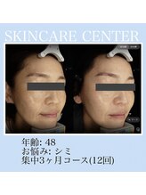 アンジェラックス スキンケアセンター 渋谷/シミ・色むら改善