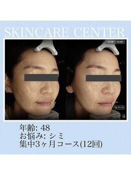 アンジェラックス スキンケアセンター 渋谷/シミ・色むら改善