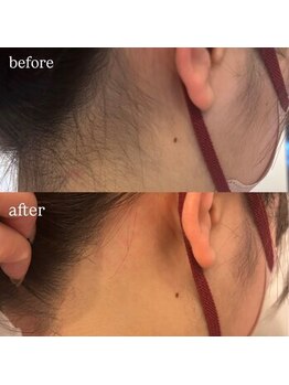 エクシア 平塚(EXIAR)/ 【うなじwax脱毛+眉毛】