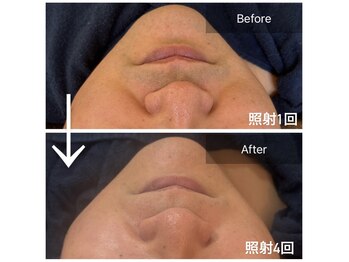 フェムーン(FEMOON)/効果抜群♪清潔感アップヒゲ脱毛