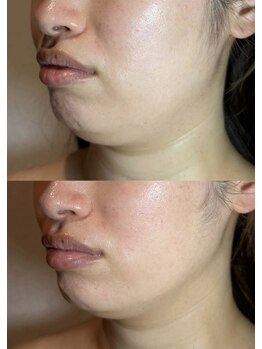 ラノン(LANON)/ビフォーアフター13