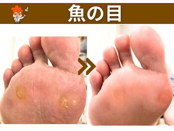 ポドウオーク(PODO WALK)/魚の目