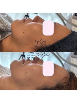 韓国肌管理室pom.haneul【ポムハヌル】LDM/インモード/ララピール/プラピール福岡天神/韓国肌管理室