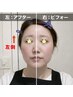 フローズンリフトプロ☆フェイス顔8000shot!今だけ15000円!(通常33000円)