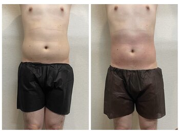 アールセカンド(R.Second)/痩身