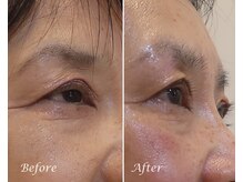 ドクターボディ 新宿店(Dr.Body)/【目の開き/まぶた　60代】